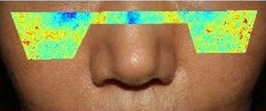 4주 사용 후 — 코 아래 얼굴 사진, 좌우 볼에 겉 멜라닌 색 지도