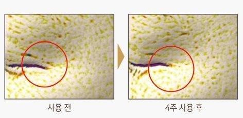 눈가 피부 표면을 촬영한 사진 두 장. 사용 전과 4주 사용 후, 빨간 원으로 주름 부위 표시