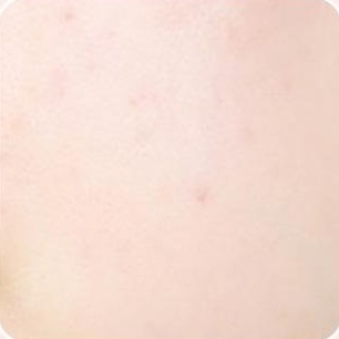 사용 전 — 뺨 피부를 가까이 찍은 사진. 붉은 잡티가 보인다